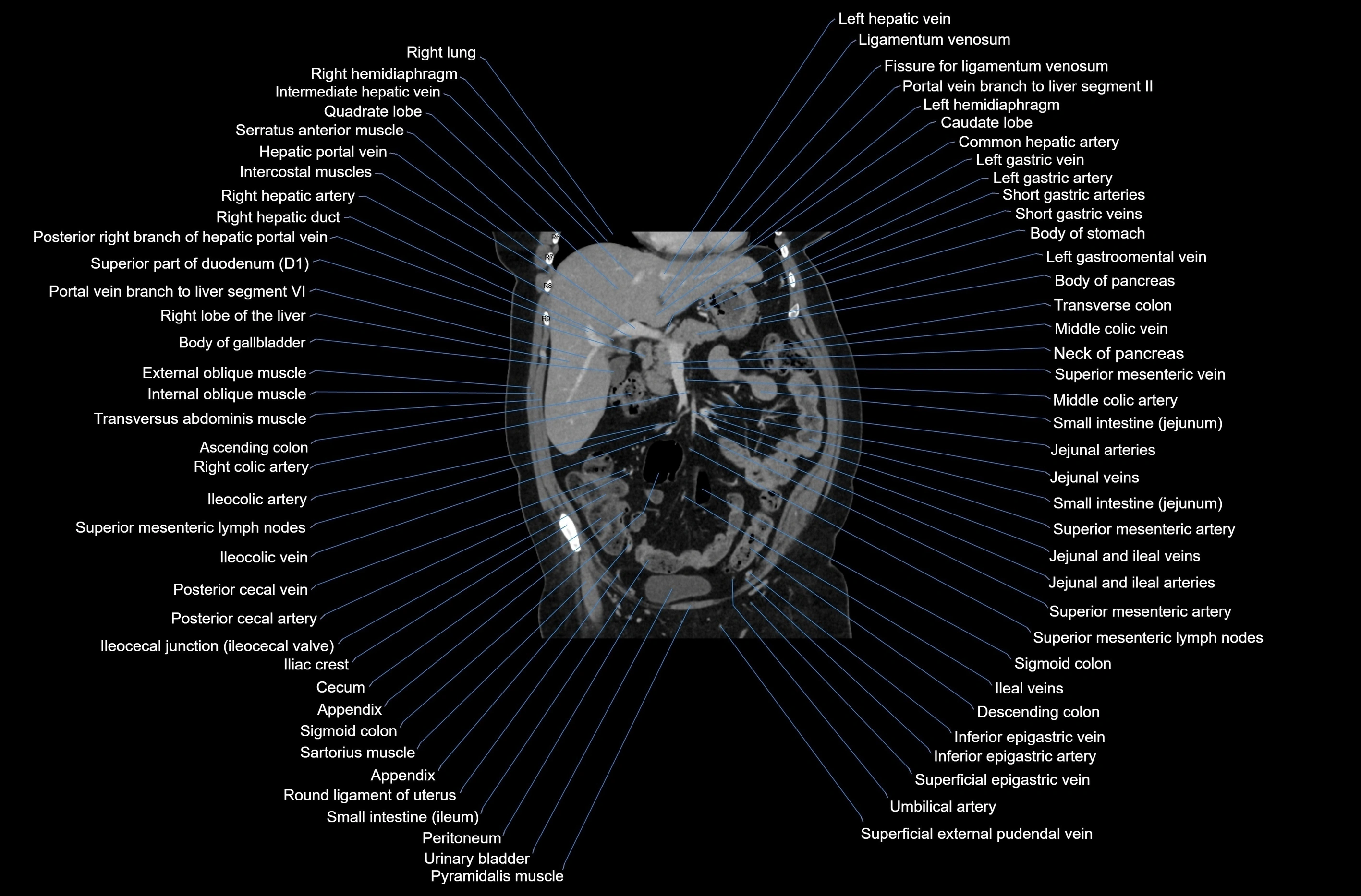 CT abdomen coronal cross sectional anatomy labelled radiology image-00033.webp